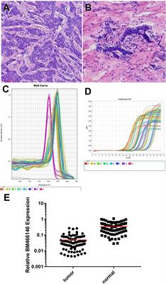 Overexpression of LncRNA BM466146 Predicts Better Prognosis of Breast Cancer